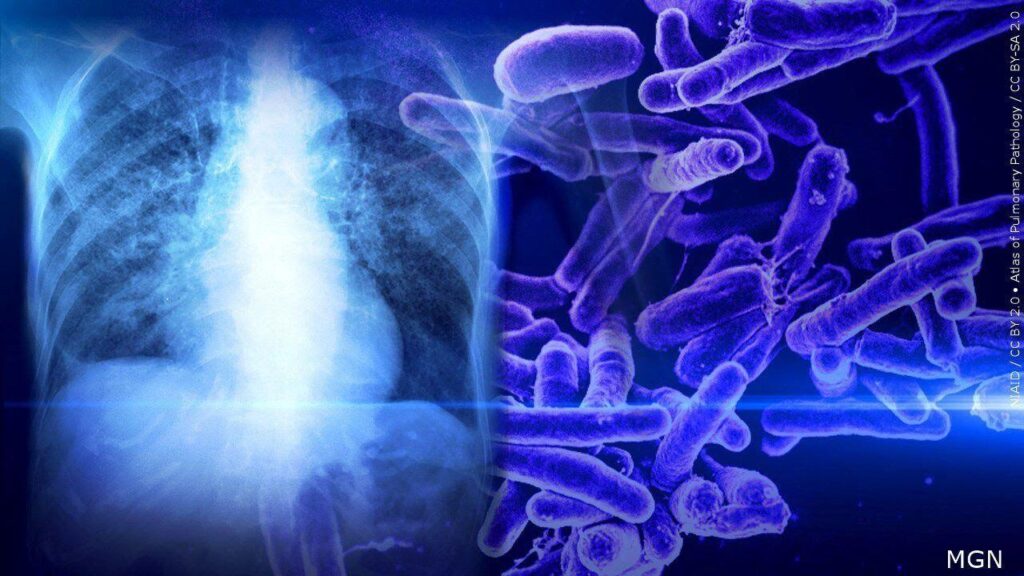 The tuberculosis outbreak in Kansas is alarming. It’s not the biggest in US history though, CDC says – AP News