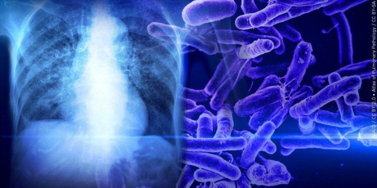 The tuberculosis outbreak in Kansas is alarming. It’s not the biggest in US history though, CDC says – AP News