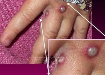 United States’ first known case of more severe strain of mpox confirmed in California – CNN