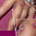 United States’ first known case of more severe strain of mpox confirmed in California – CNN